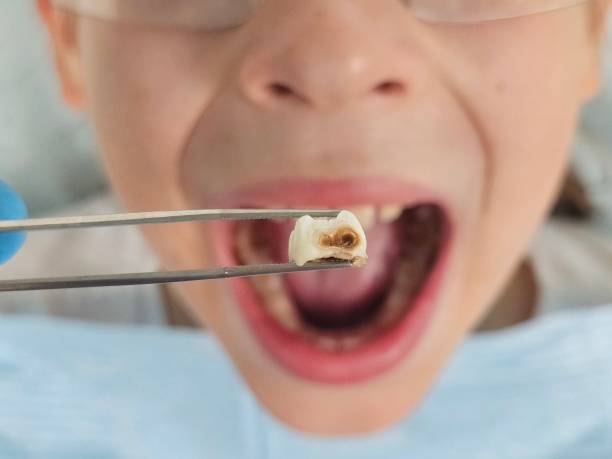 Best Broken or Chipped Tooth Repair in Villanova, PA